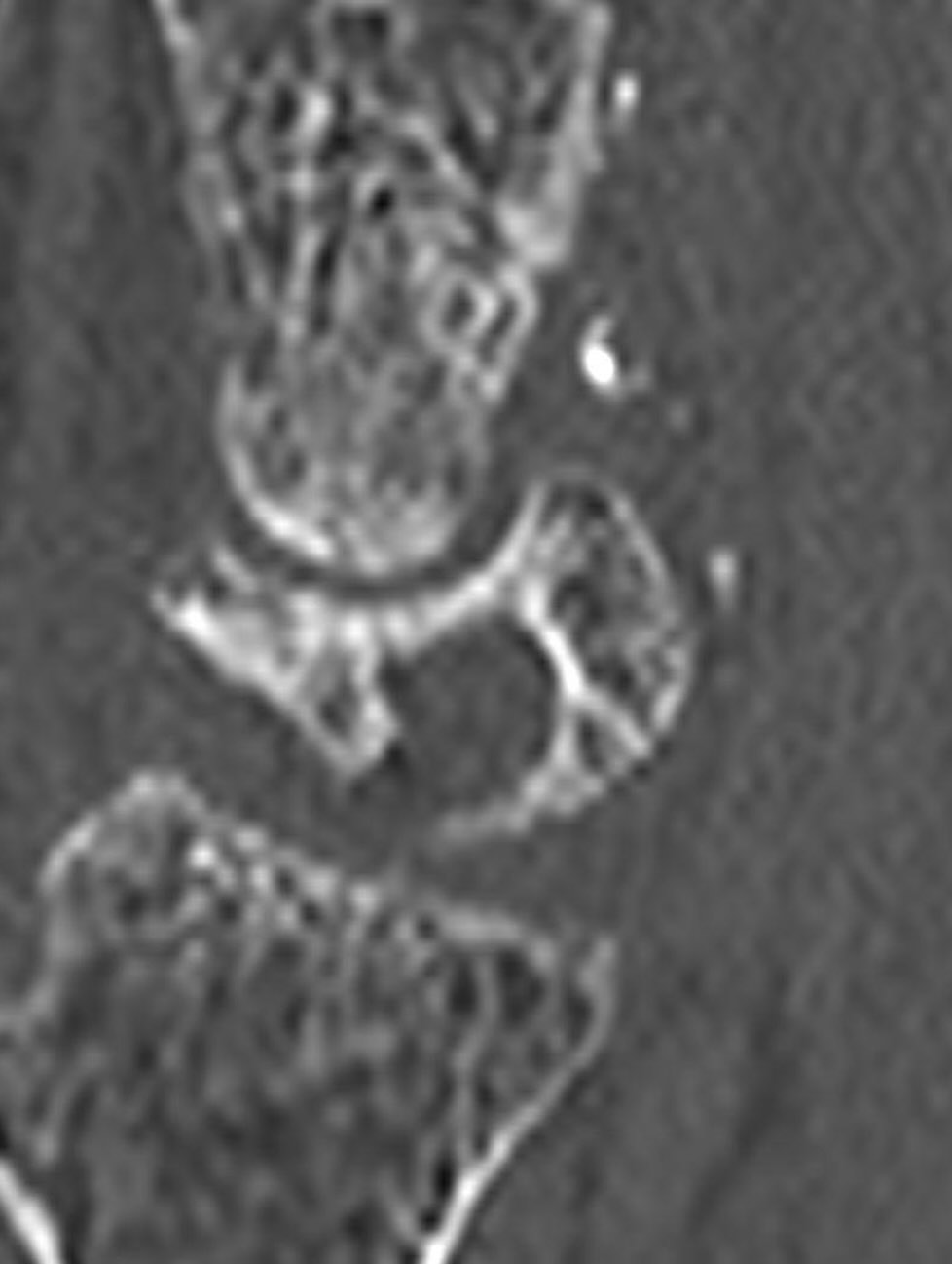 chist-osos-la-nivelul-mainii-premiera-nationala-clinica-de-chirurgia-mainii-dr-vilcioiu.jpg.4